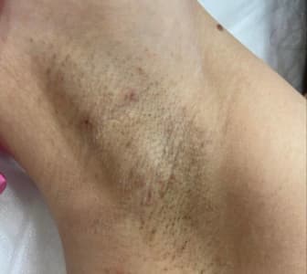 Кожа после шугаринга